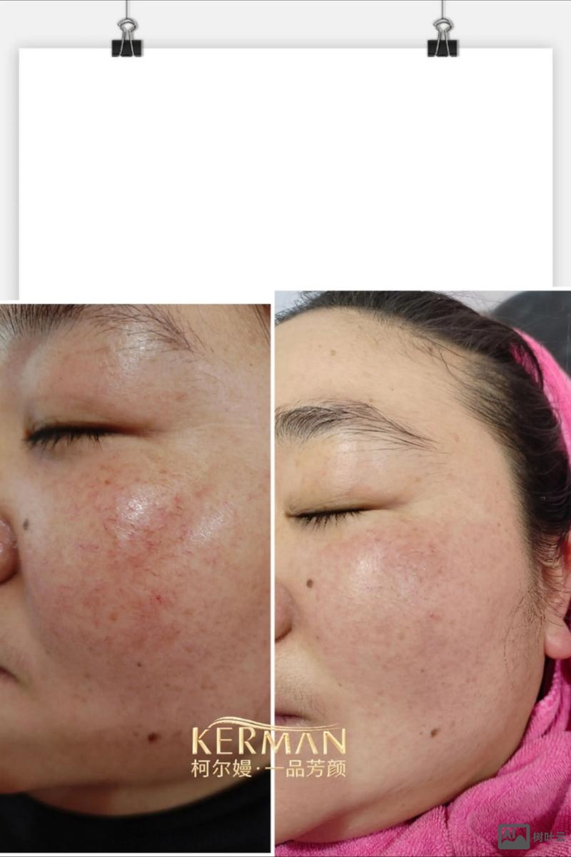 如何利用ps弄成有脸部血丝