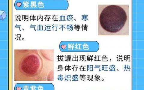 拔罐是痛还是爽?那种感觉咋形容?